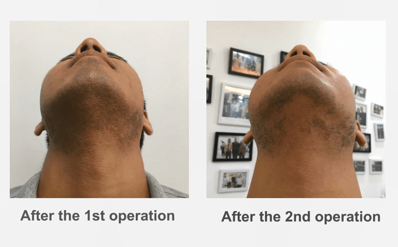 before after