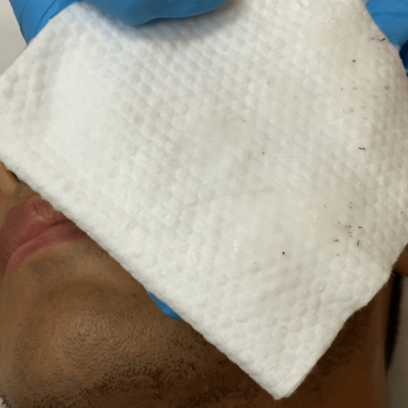 laser hair removal