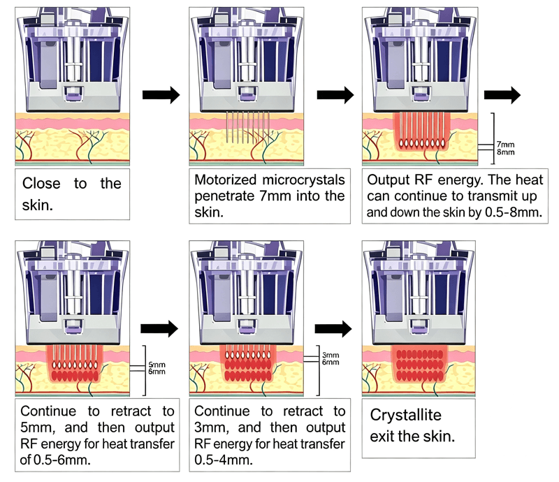 RF fractional microneedling