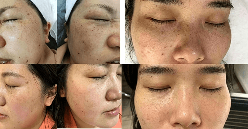 skin rejuvenation