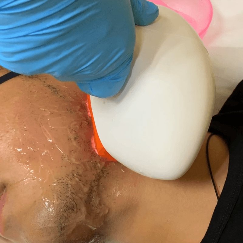 OPT hair removal