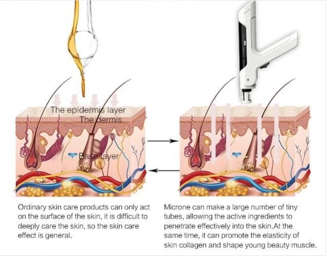 MTS microneedles