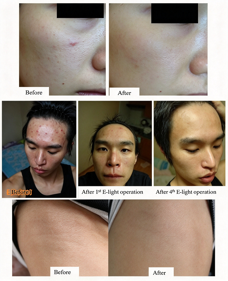 E-light beauty machine before after